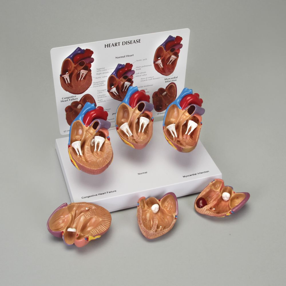 GPI Anatomicals® Human Heart Disease Model | Carolina Biological Supply