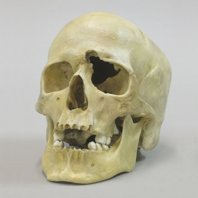 Human Male Skull With A 32 Caliber Gunshot Wound