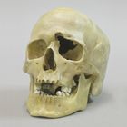 Human Male Skull with a .32-Caliber Gunshot Wound