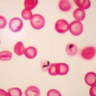 Plasmodium Falciparum Slide Smear