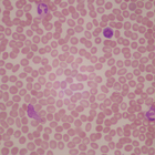Human Infectious Mononucleosis Slide, Smear, Wright's Stain