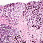Human Melanoma Slide, 7 &#181;m, H&E