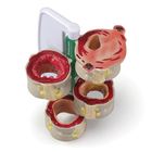 GPI Anatomicals&reg; 4-Piece Human Colon Model with Pathologies