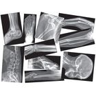 Broken Bones X-Rays, Set of 15