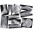 Broken Bones X Rays Set Of 15