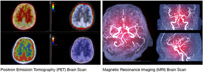 side by side comparison of PET scan and MRI scan